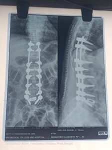 Dorso lumbar fusion surgery for d11 and l1 compression fracture with progressive kyphosis
