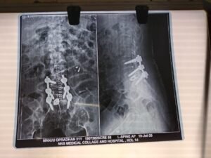 Lumbar fusion for l5 and s1 anterolisthesis