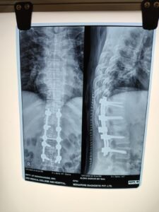 Spinal stabilisation for traumatic D12 compression fracture