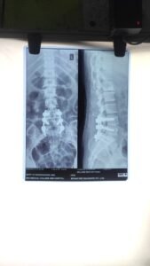 Lumbar fixation for l4,l5 and l5 s 1 canal stenosis