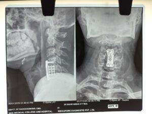 Anterior cervical corpectomy for CSM