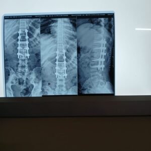 Stabilisation of l1 compression fracture